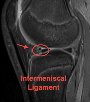 MRI Intermeniscal Ligament